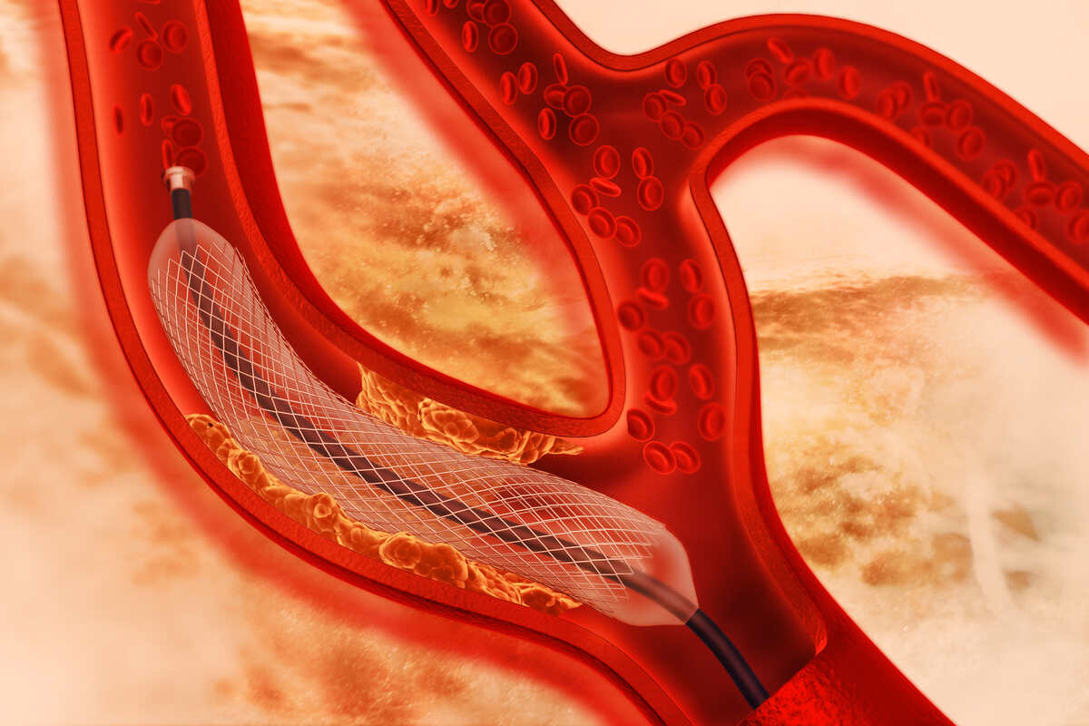 Kako se ugrađuje stent i šta je angioplastika