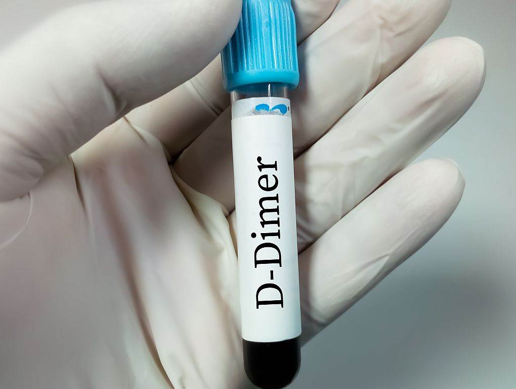 d dimer laboratorija analiza krvi referentne vrednosti Lepa i srećna