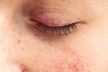 ekcem na ocima dermatitis kapc-min.jpg