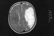 Čudo medicine: Džejk Gledstoun (4) živi sa polovinom mozga