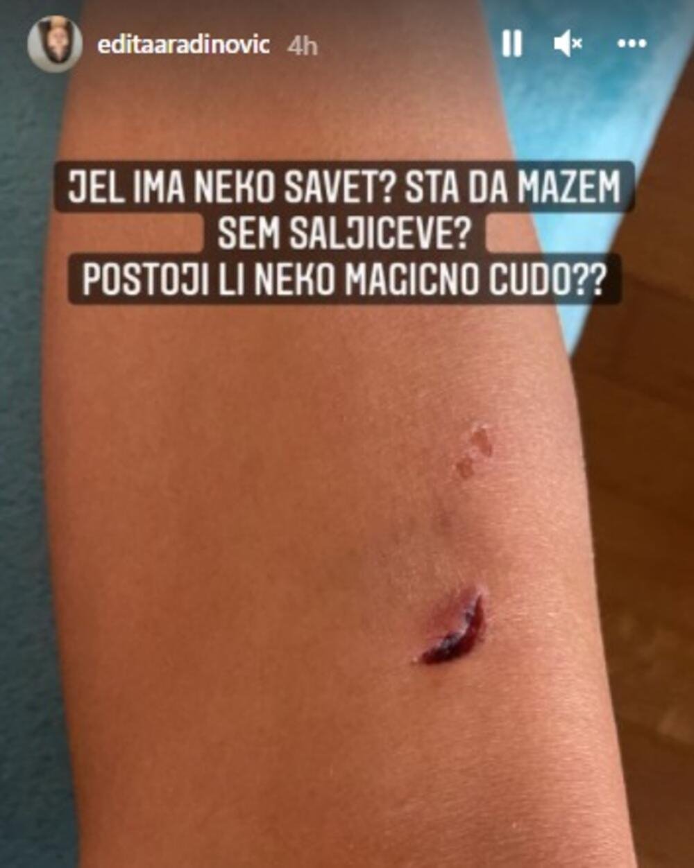 Edita Aradinović povreda