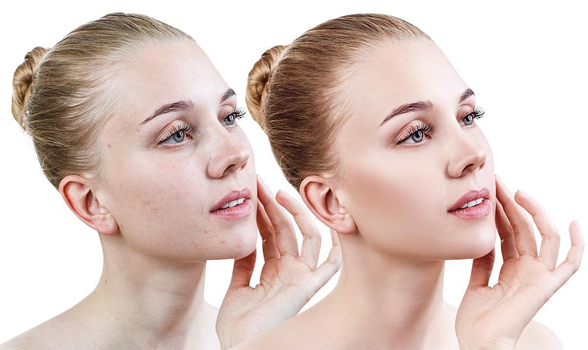 akne cista koza 0345703886.jpg