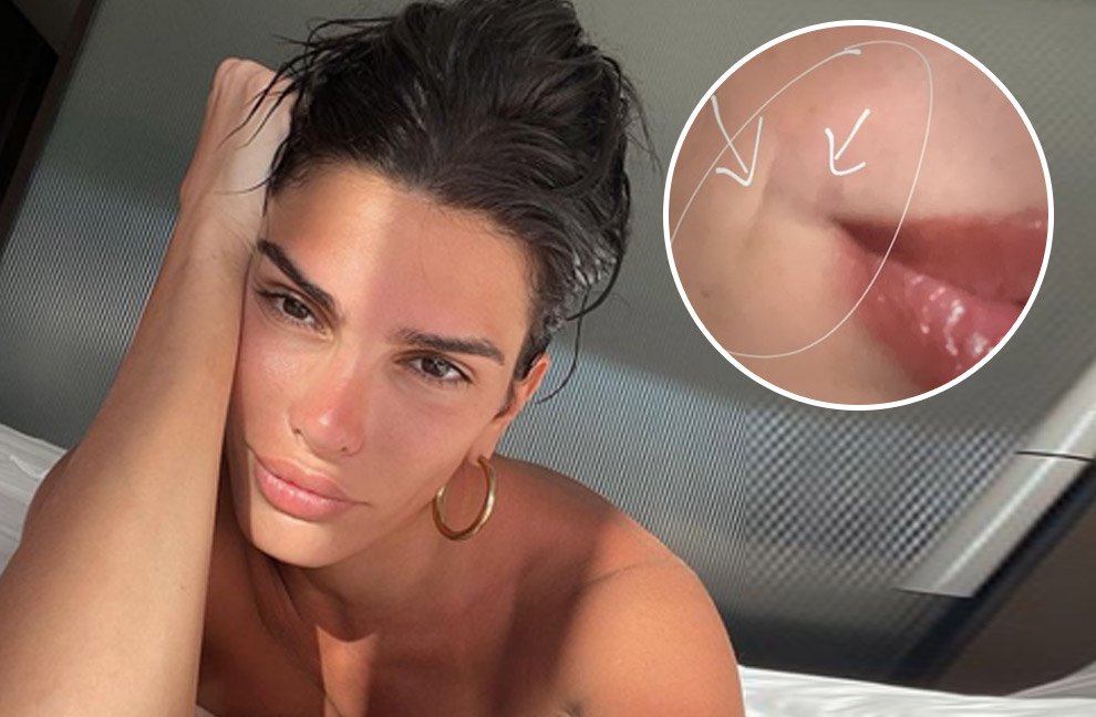 Jovana Švonja o estetskim korekcijama