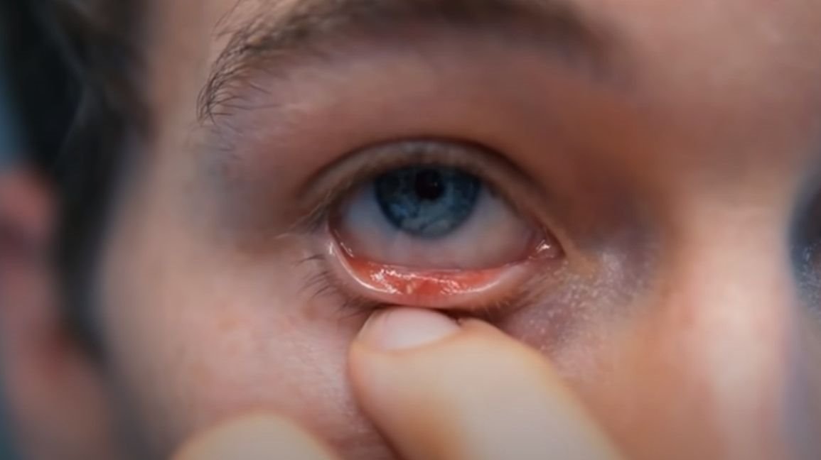 Nedostatak vitamina A