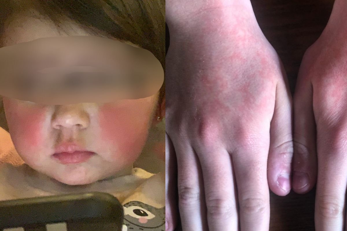 peta bolest eritem infektivni