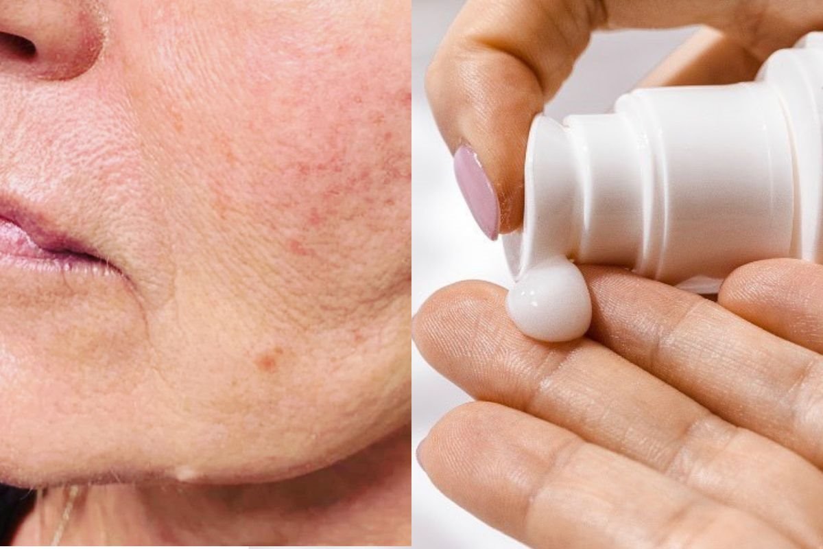 suncanje solarna elastoza