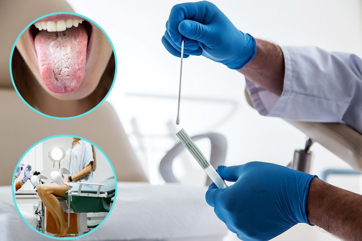 kandida pregled usta vaginalna