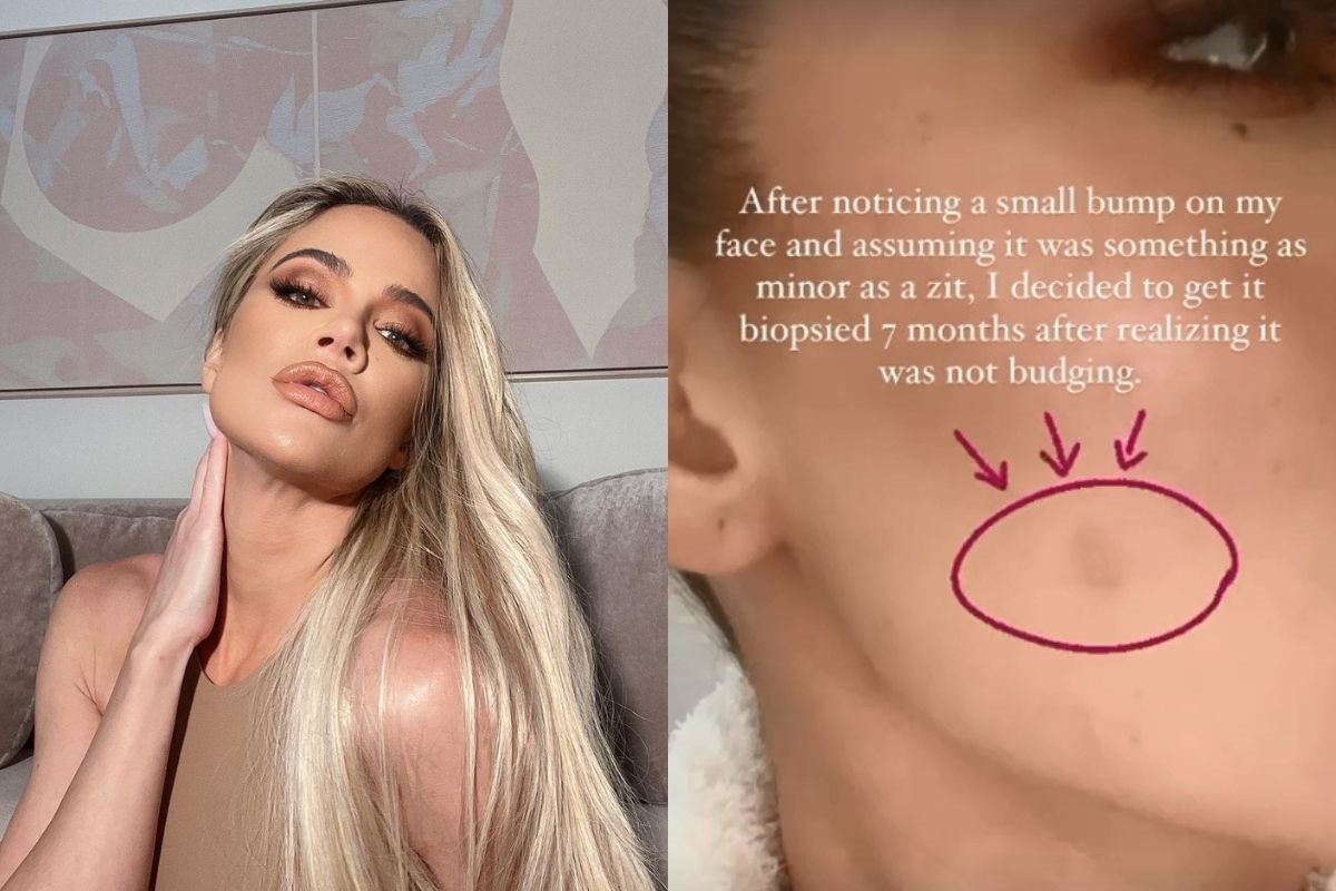 kloi kardasijan tumor 2.jpg