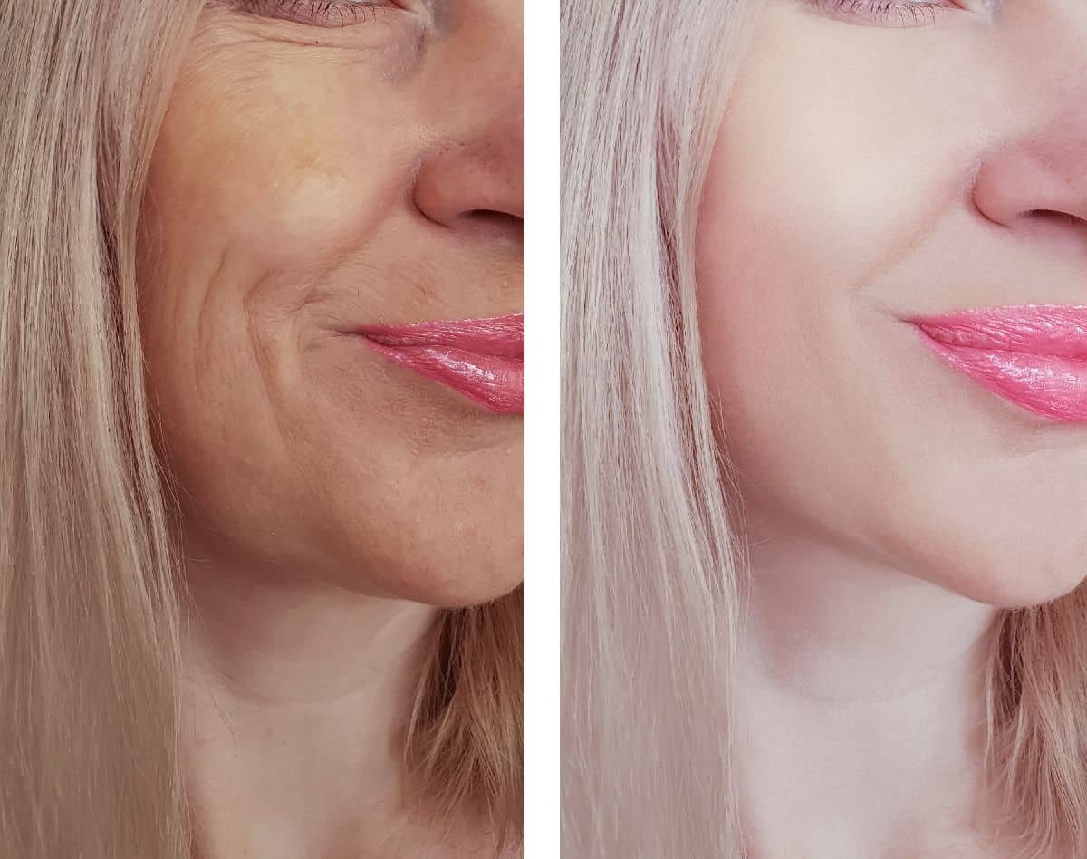 botoks pre i posle-min.jpg