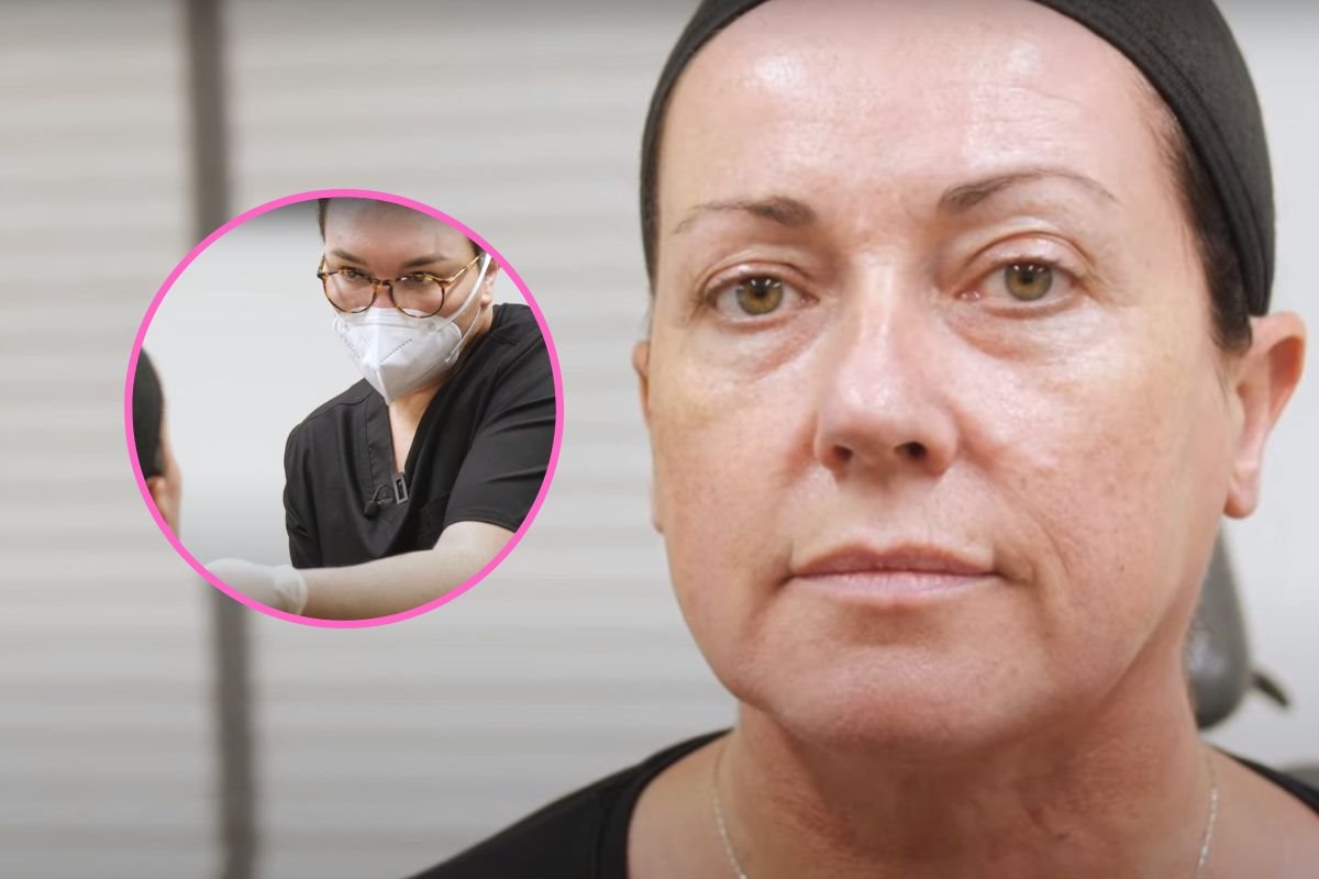 hijaluronski fileri u obrazima i jagodicama.jpg