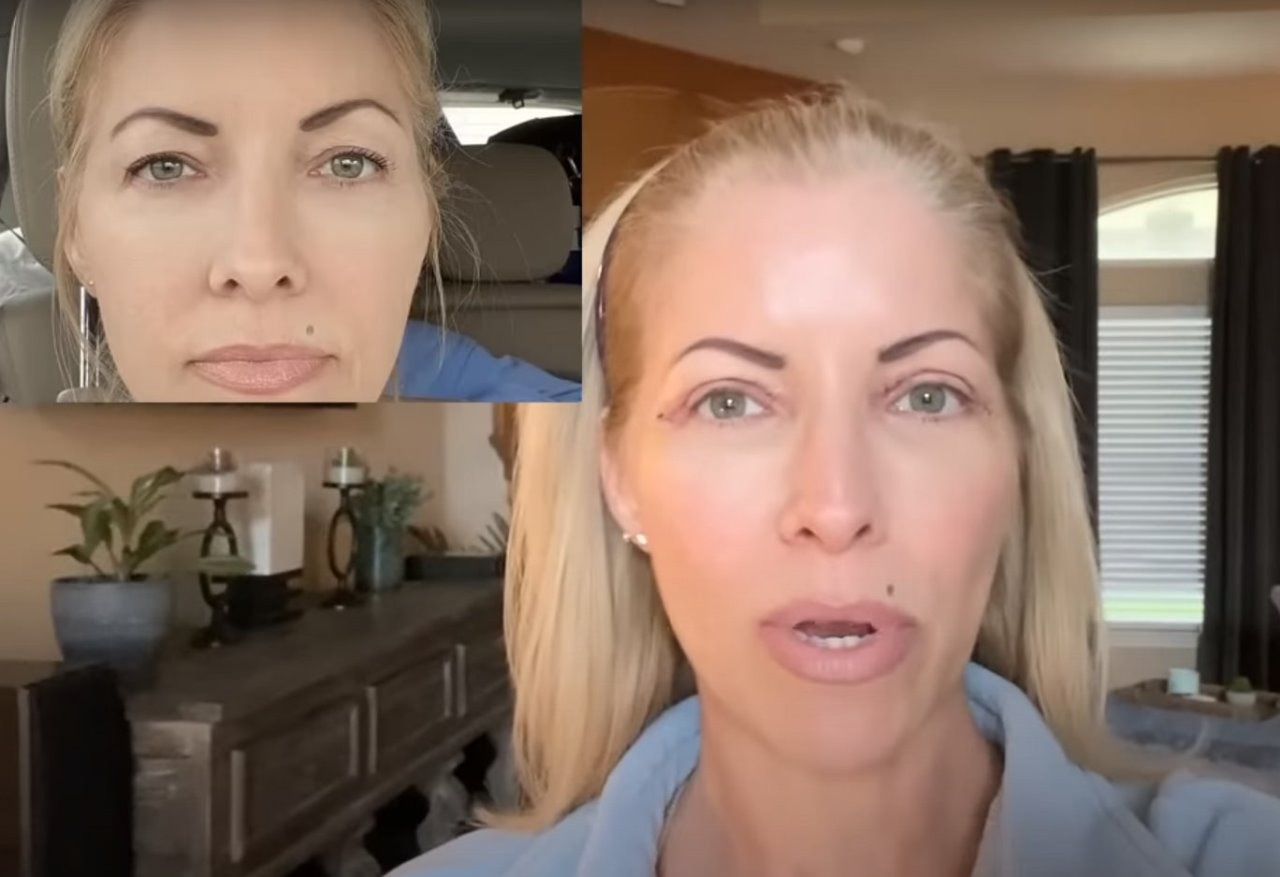 blefaroplastika operacija kapaka-min.jpg