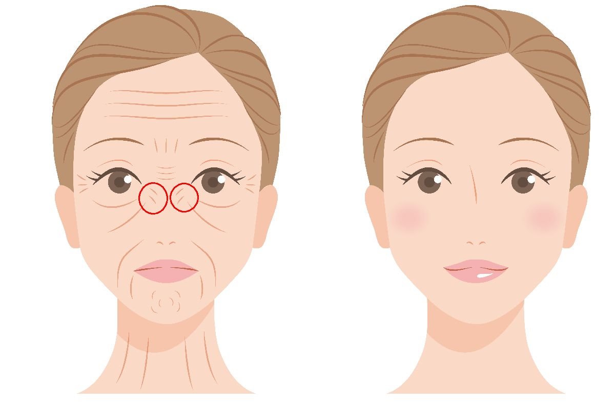 bunny lines lice bore 2.jpg