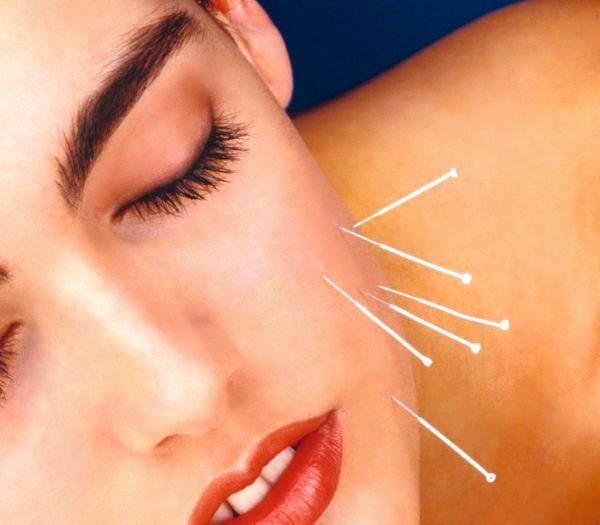 Fejslifting bez operacije: da li akupunkturom možemo da zategnemo kožu lica (FOTO)