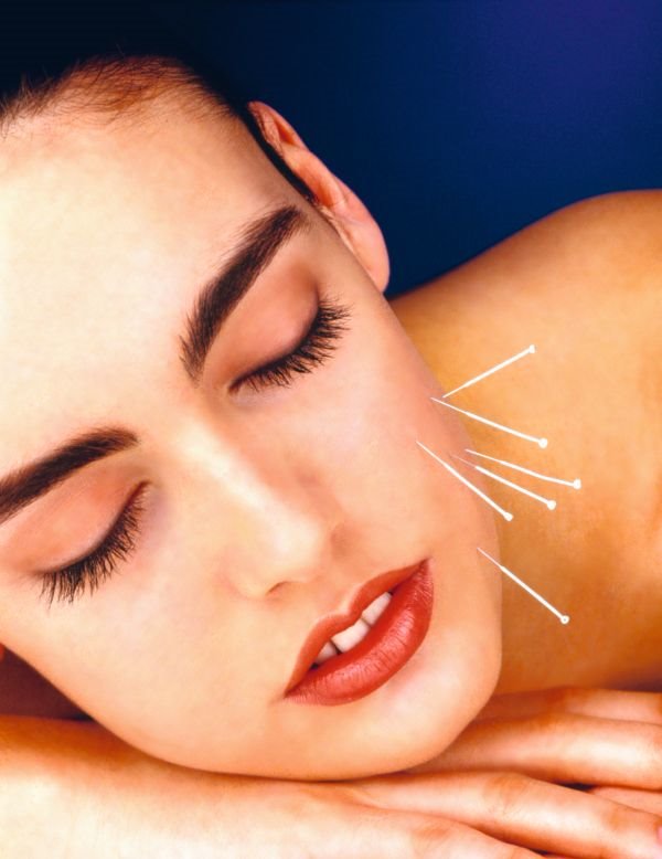 Fejslifting bez operacije: da li akupunkturom možemo da zategnemo kožu lica (FOTO)