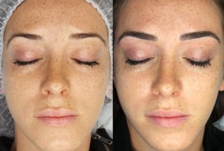 Polutrajna šminka za savršene obrve: zašto kozmetičari preporučuju mikroblejding (FOTO + PRE i POSLE)