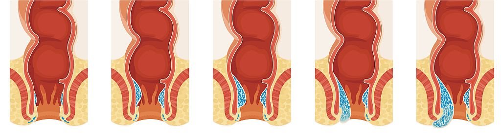 Hemoroidi - normalni i 4 stadijuma