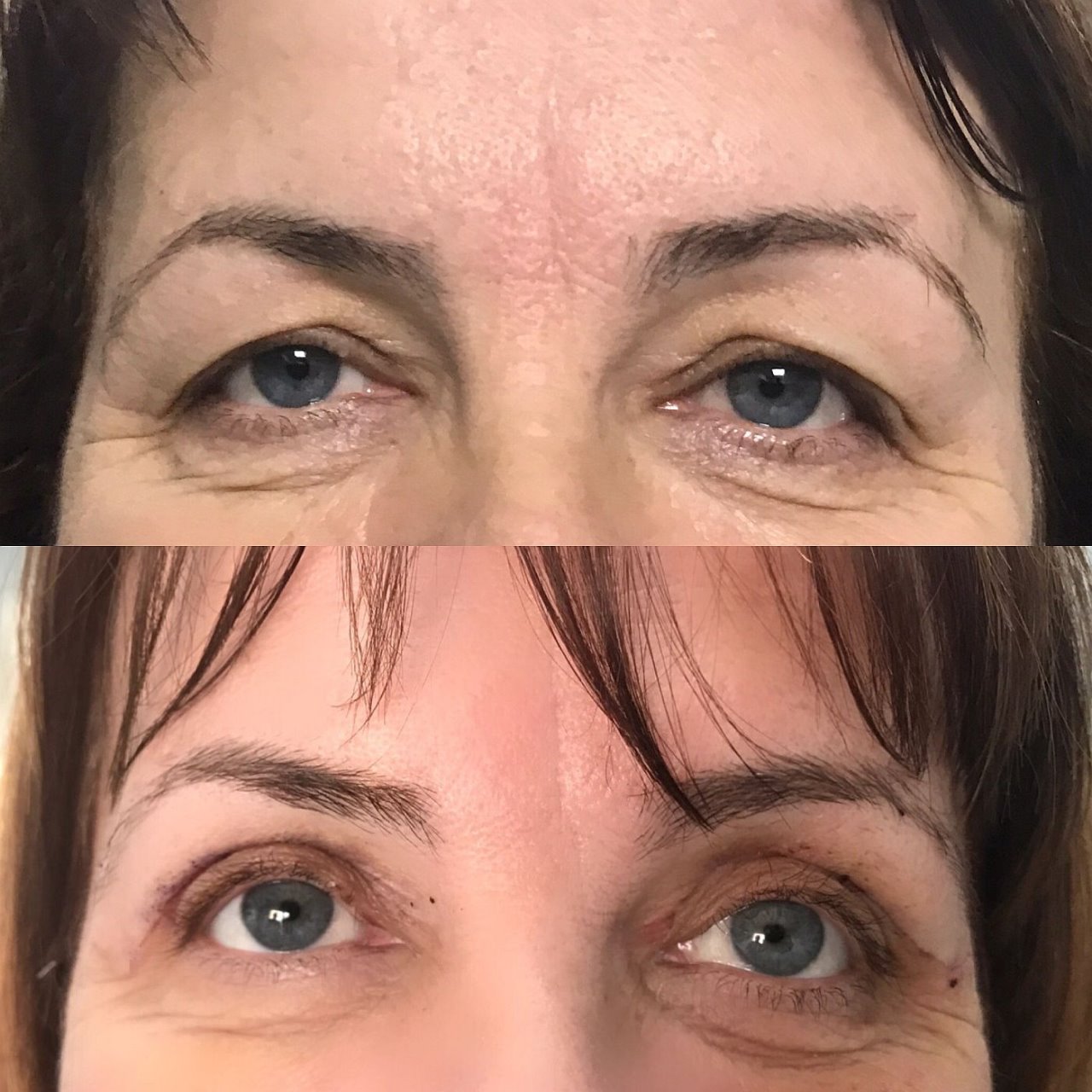 blefaroplastika zatezanje kapaka pre i posle