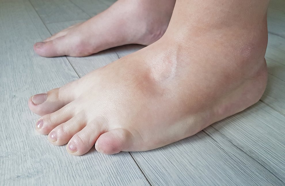 Simptomi lipedema i limfedema sličnosti i razlike