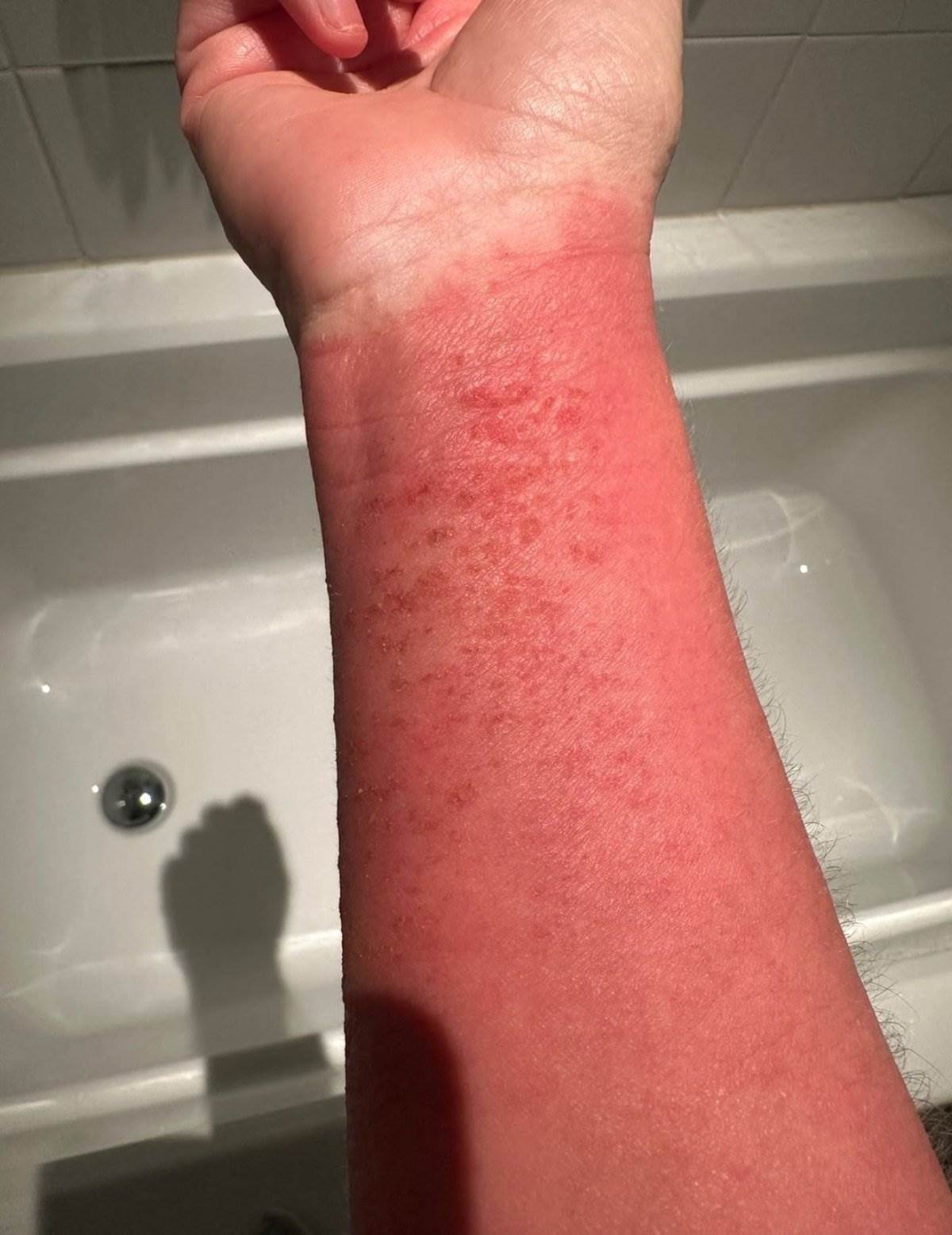 Ineta Petrajte o problemima sa kožom nakon korišćenja steroidnih krema