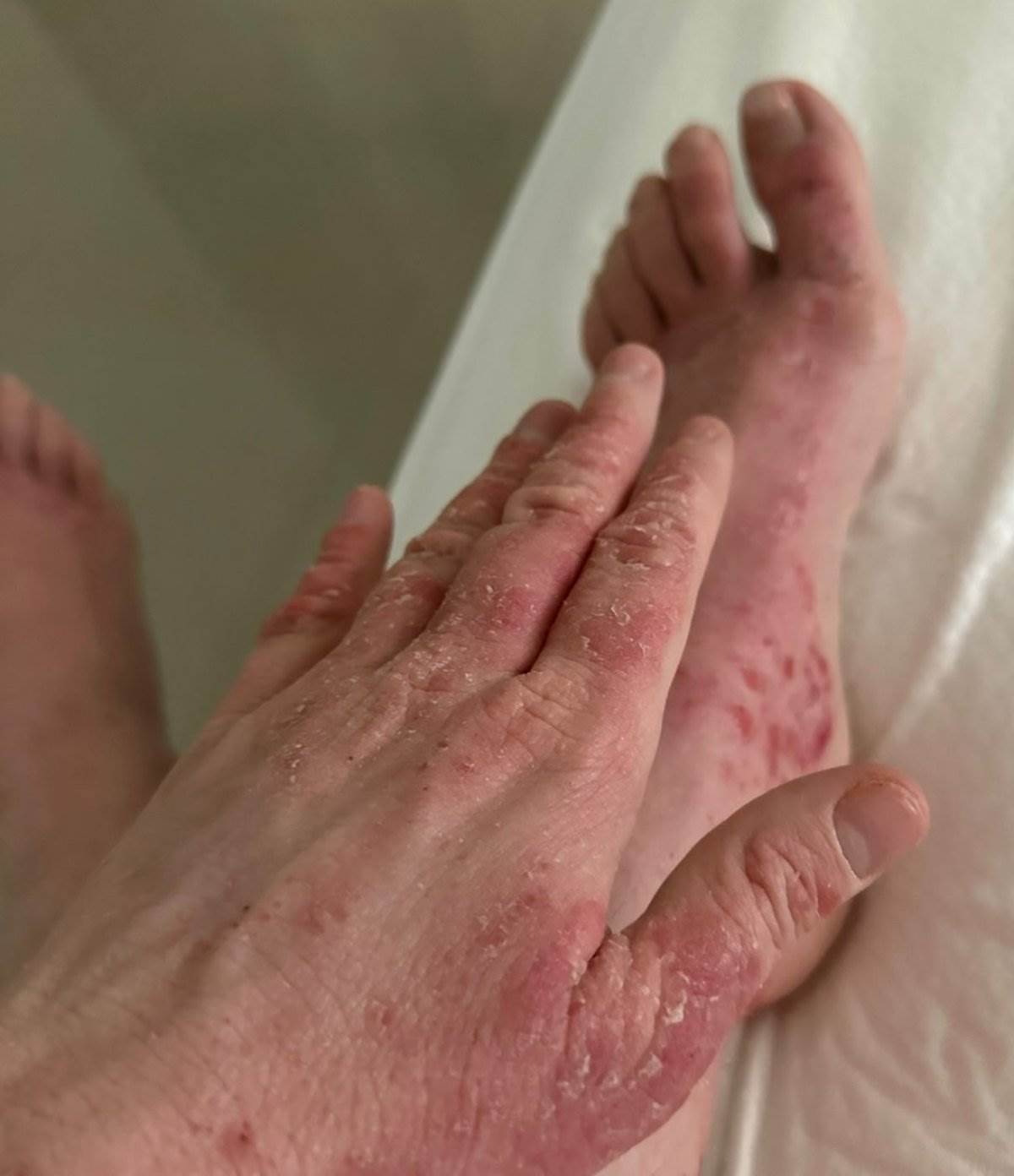 Ineta Petrajte o problemima sa kožom nakon korišćenja steroidnih krema