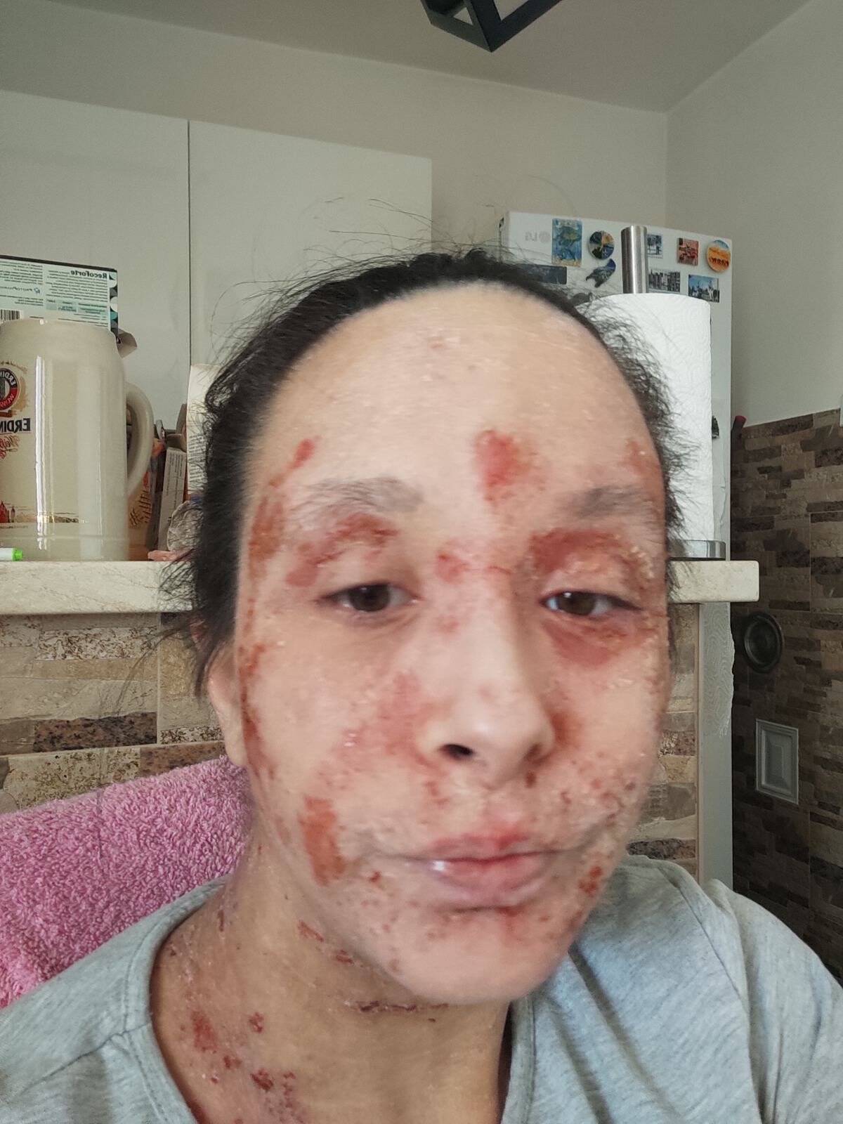 Anđela Tonić i TSW sindrom