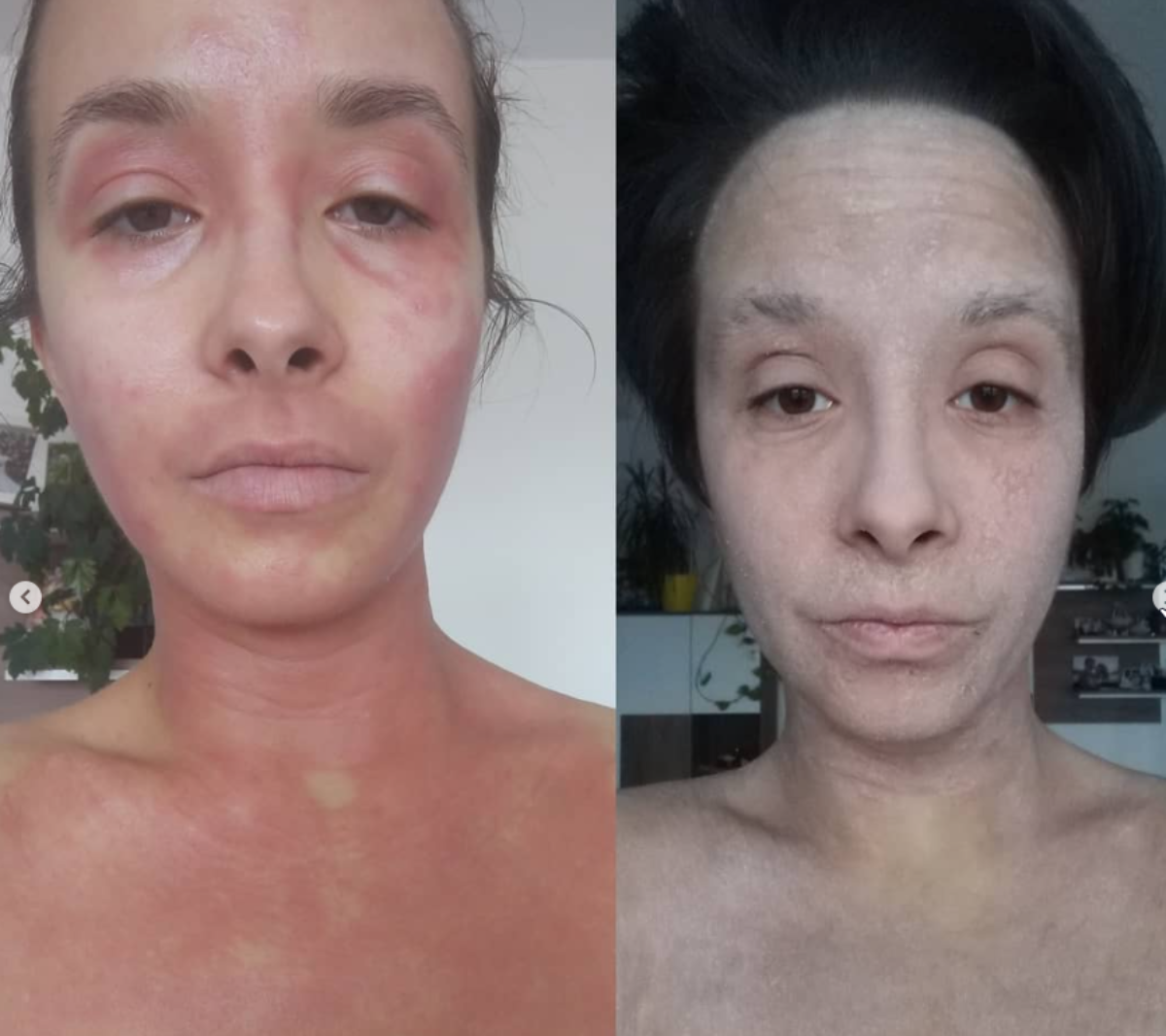 Anđela Tonić i TSW sindrom
