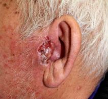 rak koze karcinom 08.jpg