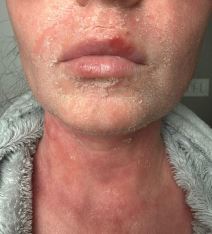 Ineta Petrajte o problemima sa kožom nakon korišćenja steroidnih krema