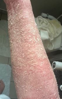 Ineta Petrajte o problemima sa kožom nakon korišćenja steroidnih krema