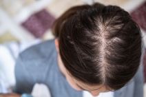 Proređena kosa kod žene