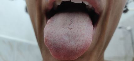 beli jezik dehidratacija.jpg