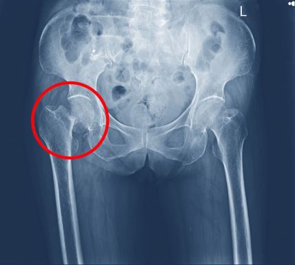 prelom kuka fraktura osteoporoza.jpg