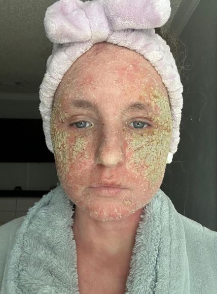 Ineta Petrajte o problemima sa kožom nakon korišćenja steroidnih krema