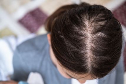 Proređena kosa kod žene