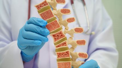 osteoporoza kičma