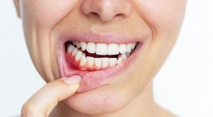 gingivitis upala desni.jpg