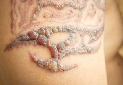 Skidanje tetovaže