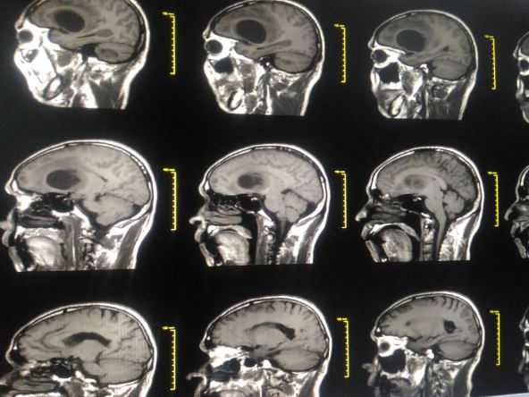 glioblastoma tumor na mozgu.jpg