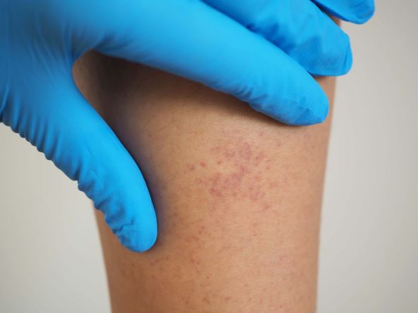modrica leukemija.jpg