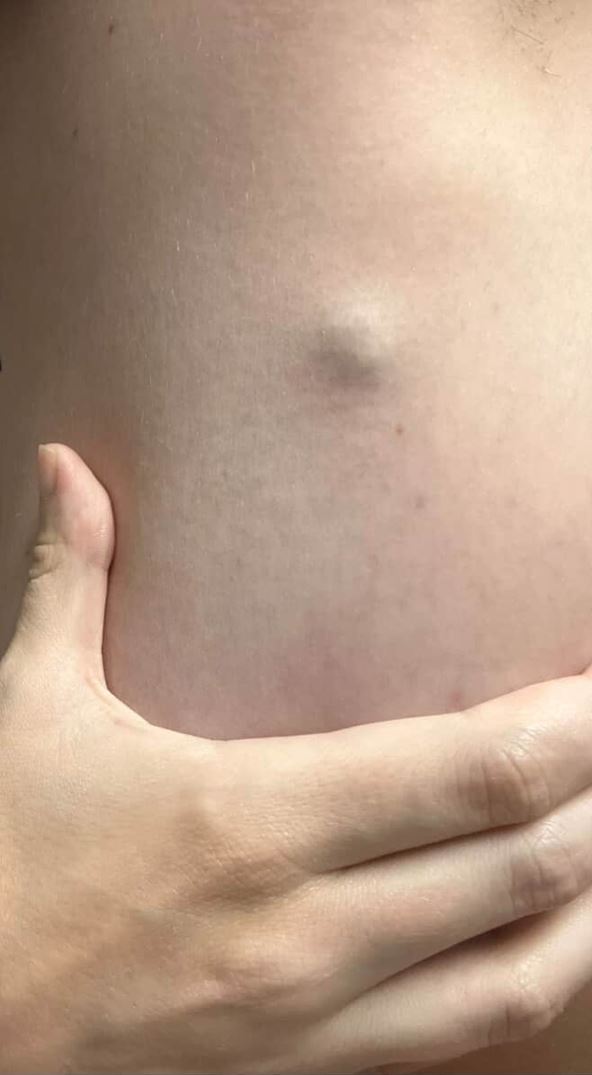 Kajli Engle i tumor