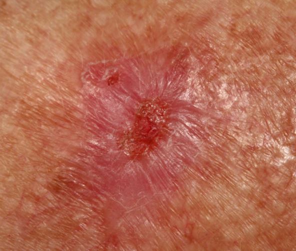 rak koze karcinom 04.jpg