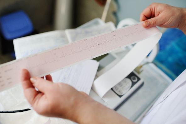 srcana aritmija ekg.jpg