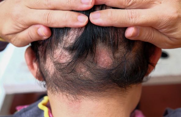 opadanje kose Alopecia areata.jpg