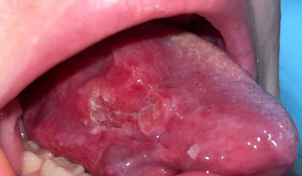 grejs brend rak jezika.jpg