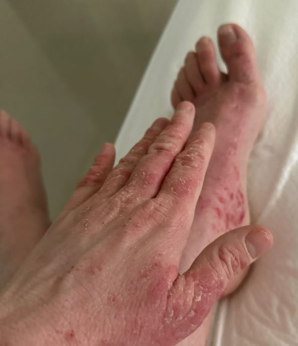 Ineta Petrajte o problemima sa kožom nakon korišćenja steroidnih krema