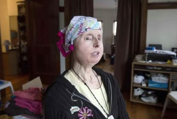 Žena koju je napala šimpanza