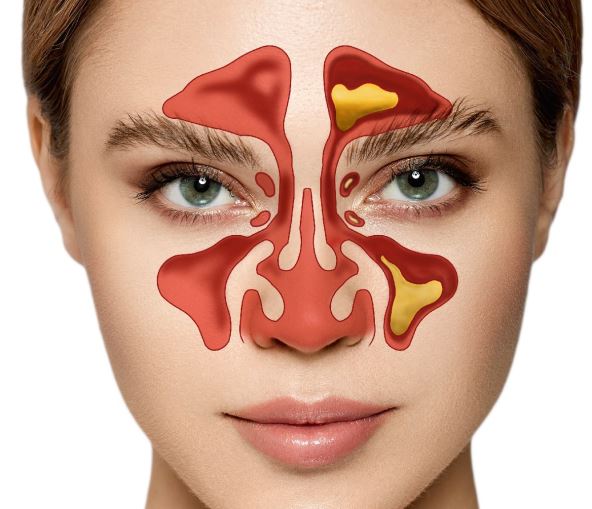 sinusitis 4.jpg