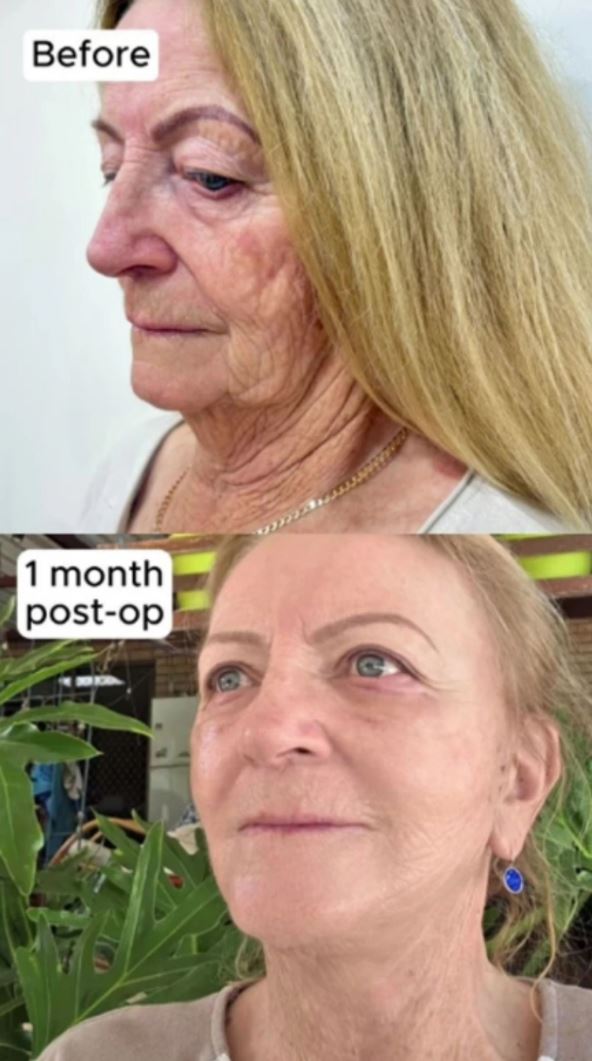 pamela uradila fejslifting 3.jpg