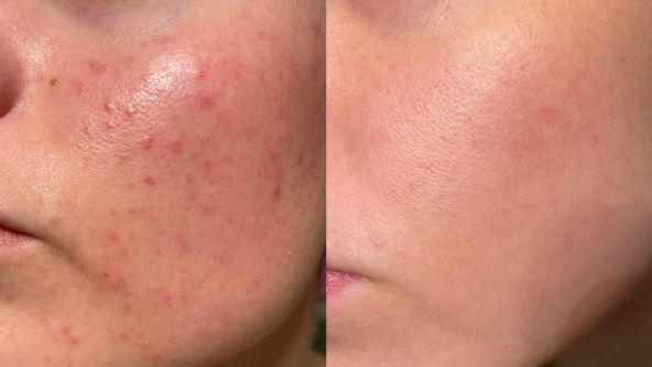 kako izlečiti bubuljice