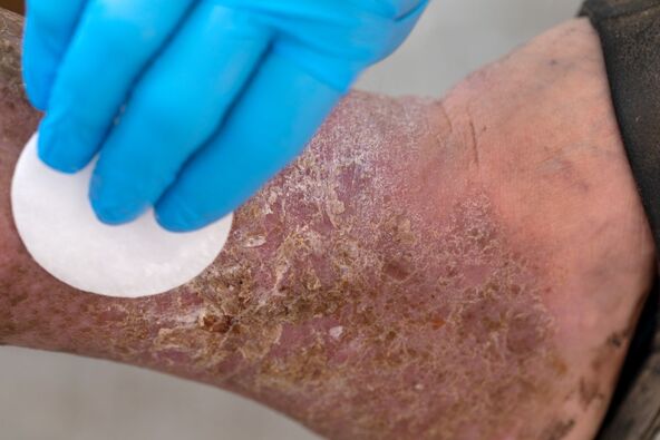 gangrena.jpg